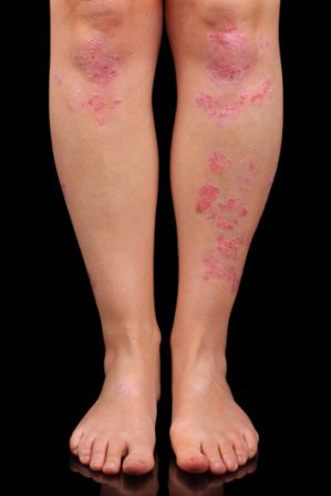 Comment soigner le psoriasis naturellement ? | OLEASSENCE Comment soigner le psoriasis naturellement ? | OLEASSENCE