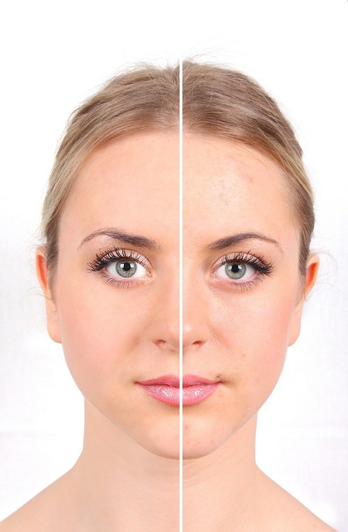 comment enlever microkyste visage