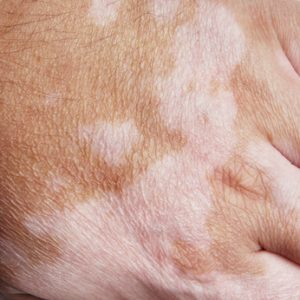 La photo jusquà et après léloignement des taches de rousseur par le laser