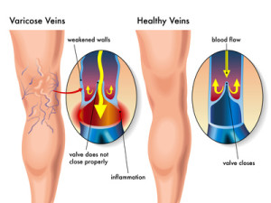 Varicosités et Veinules