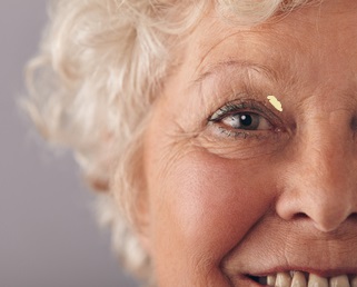 Xanthelasma femme