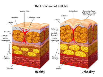 Cellulite cause Schema Coupe peau avec amas de cellulite