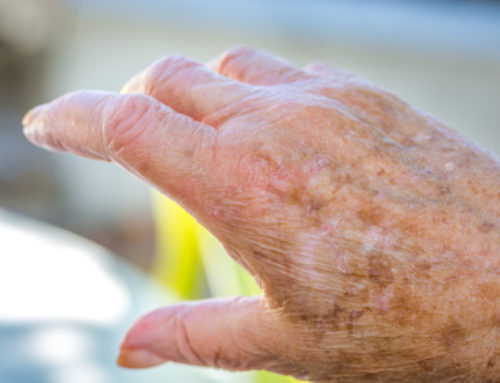 Taches blanches et brunes : comment les atténuer?