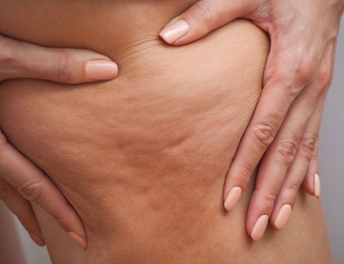 Quel est votre type de cellulite et comment agir naturellement ?