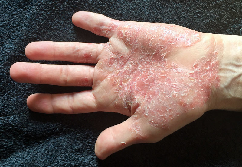 Apaiser naturellement le Psoriasis : faites vous ceci ...